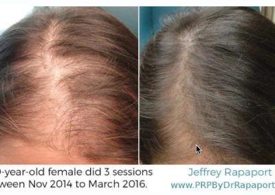 PRP For Hair Loss