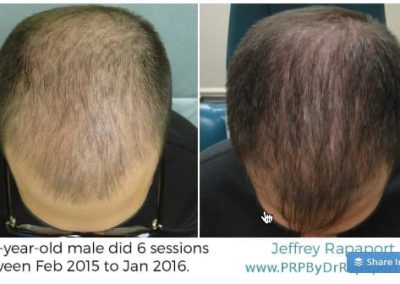 PRP For Hair Los
