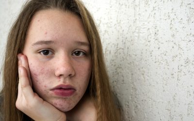 Everything You Need to Know About Accutane