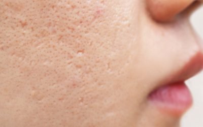 What You Need to Know About Acne Scars (Causes and Treatments)