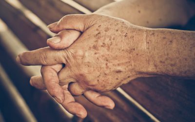 Everything You Need to Know About Age Spots