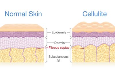 6 Misconceptions About Cellulite