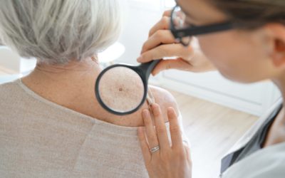 What You Need To Know About Moh’s Surgery
