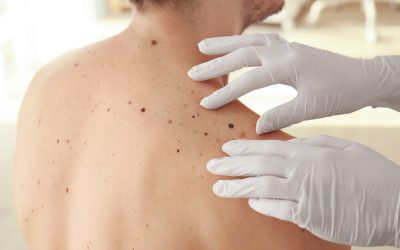Do I Really Need a Skin Cancer Check-Up?