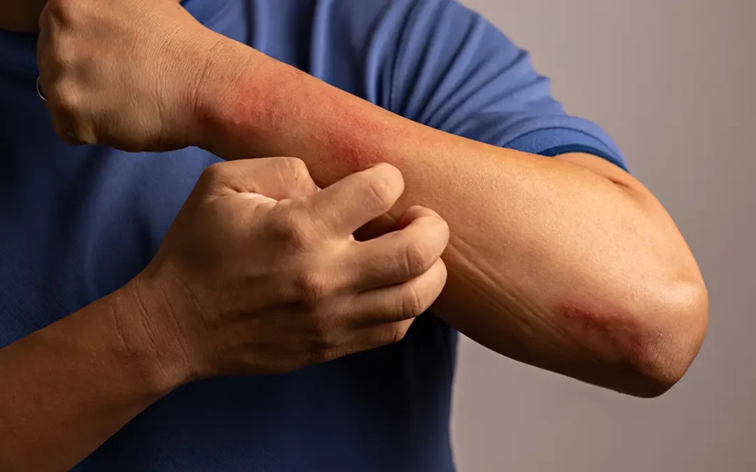 Eczema Management: Guide to Skin Health