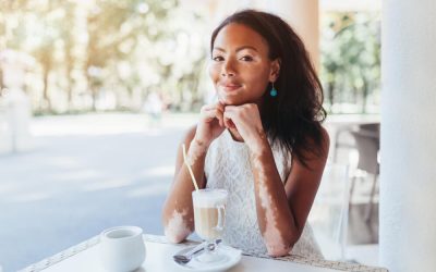 5 Facts About Vitiligo