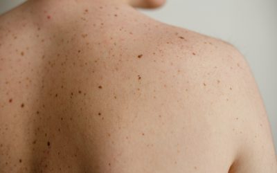 When To Worry About a Mole (And See a Dermatologist)