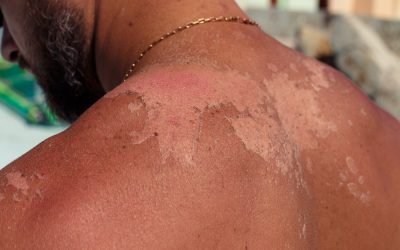 The Importance of Sunscreen for Healthy Skin