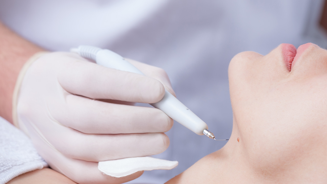 wart-removal wart removal