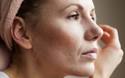 5 Ways to Treat Acne Scars That Actually Work