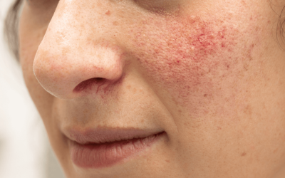 About Rosacea, By Laurel Stearns, DO